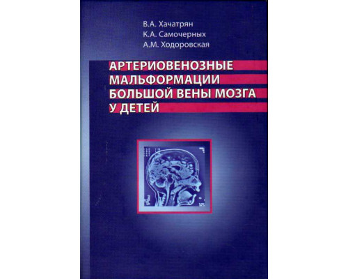 Артериовенозные мальформации большой вены мозга у детей.